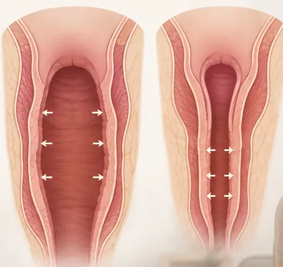 Qué es la vaginoplastia