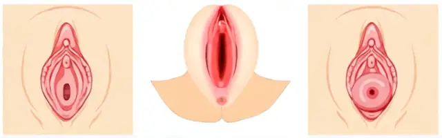 Por qué muchas mujeres confunden labioplastia y vaginoplastia