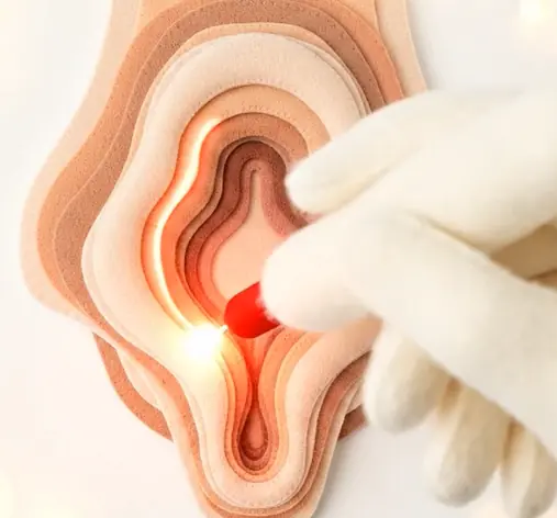 ¿Qué es la labioplastia laser y en qué consiste realmente?