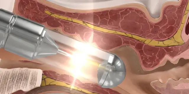 Tipos de rejuvenecimiento vaginal
